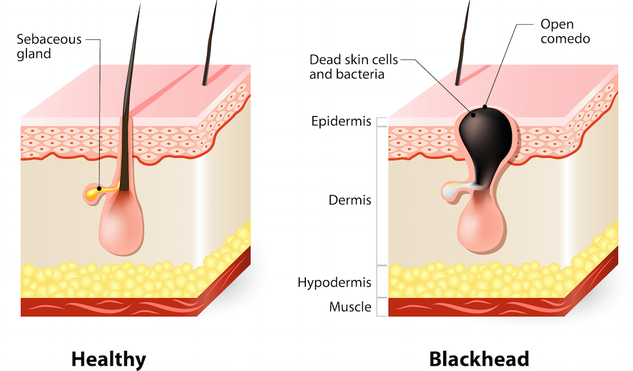 Dilated Pores – Lavishette